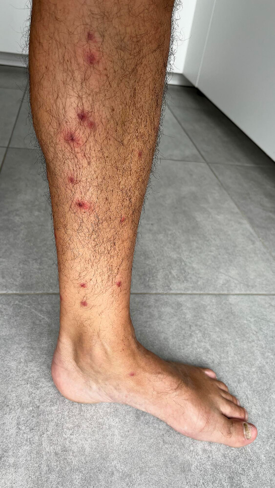 Bein mit mehreren roten Bisswunden