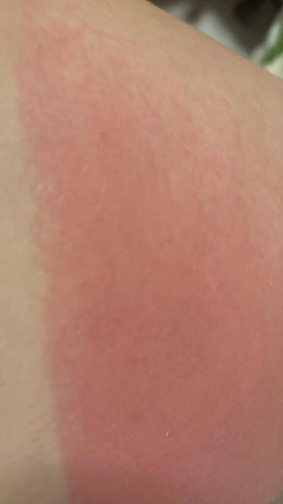 Großflächiger Sonnenbrand am Oberschenkel