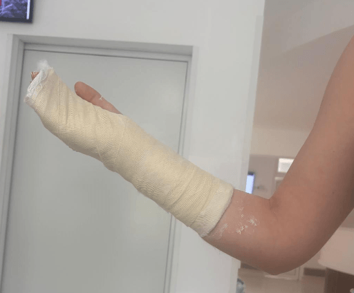 Verletzter Finger in Gips